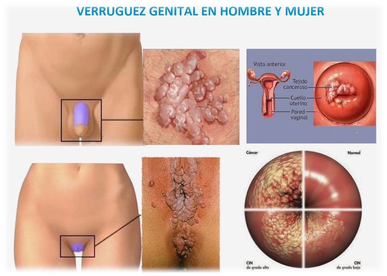 Problemas de Prostata
